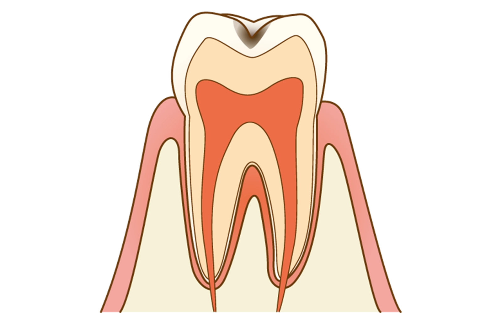 C1(エナメル質虫歯)