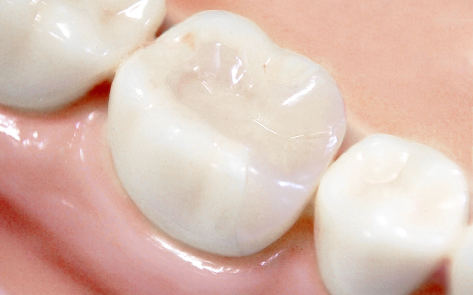 インレー(詰め物)治療