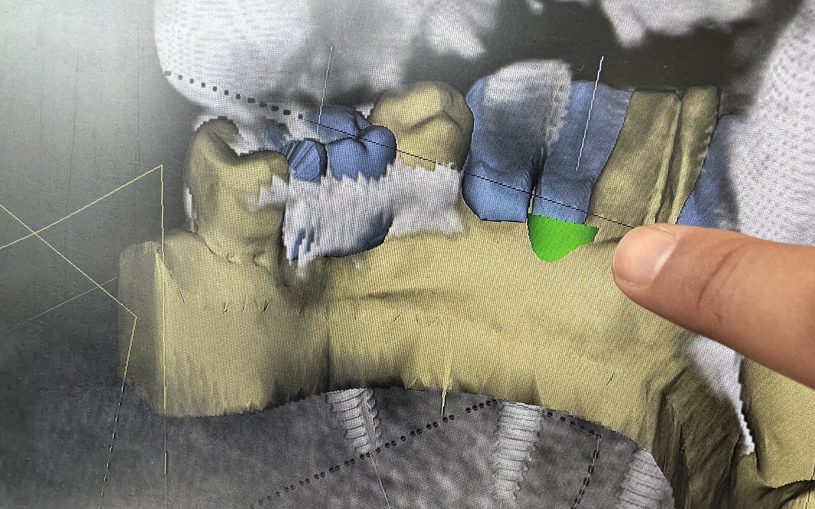 補綴専門医による精密な設計