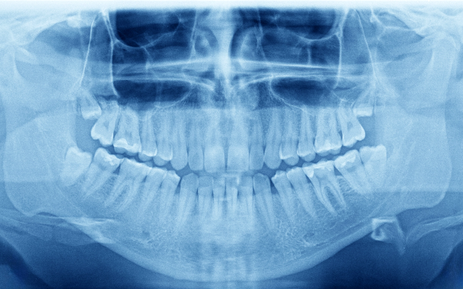 骨内腫瘍・嚢胞の治療