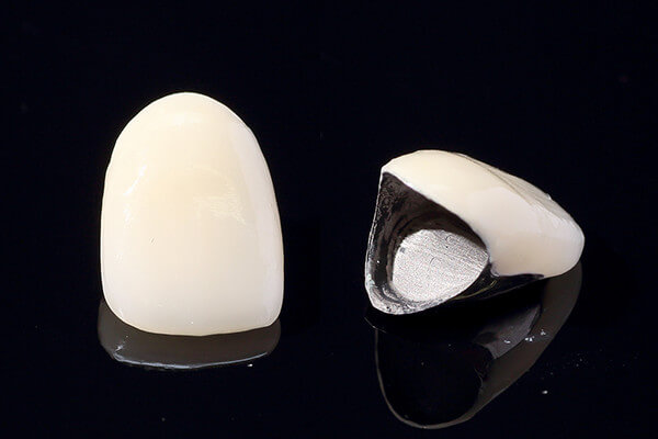 硬質レジン前装冠 硬質レジン前装冠