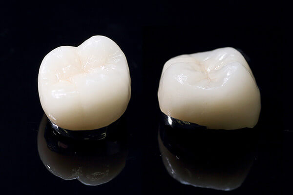 メタルボンドセラミックス メタルボンドセラミックス