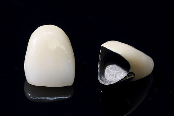 メタルボンドセラミックス メタルボンドセラミックス