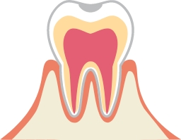初期の虫歯の場合