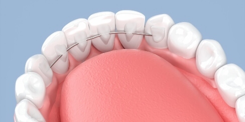 舌側矯正(裏側矯正)
