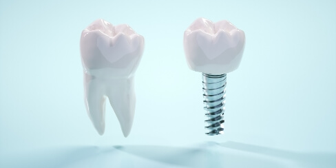 インプラント矯正