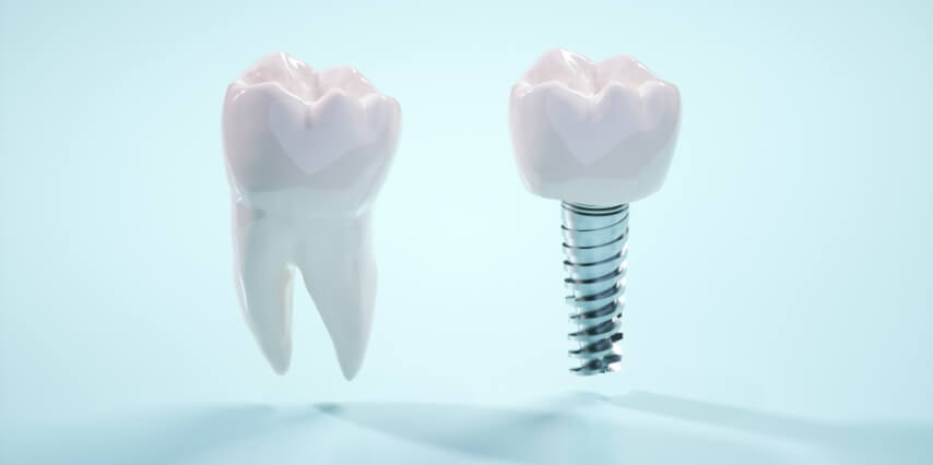 ブラケット矯正